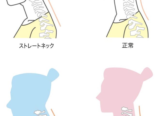 夏にストレートネックがつらくなる？／新小岩　ストレートネック