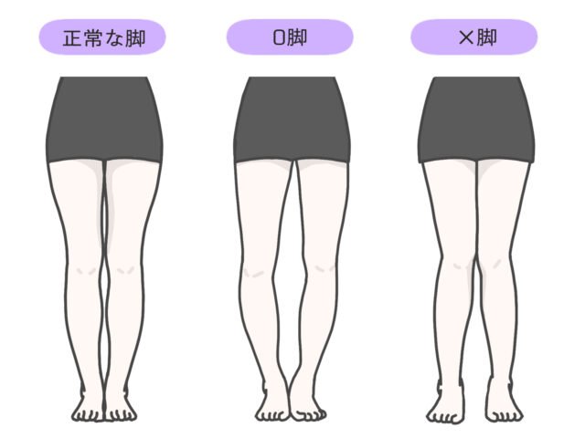 O脚が気になる方へ｜新小岩　O脚